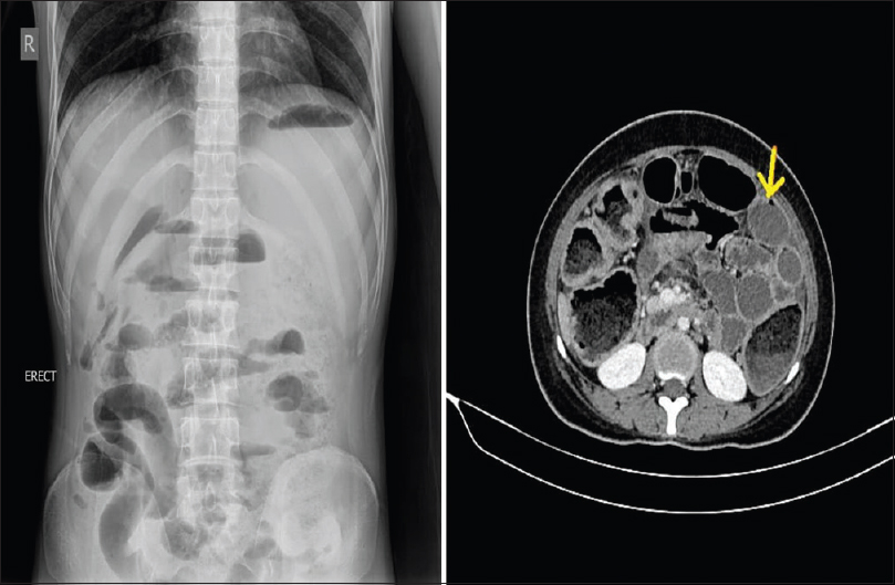 X-ray erect abdomen does not show air under the diaphragm, but contrast-enhanced computed tomography abdomen shows wall defect in the sigmoid colon